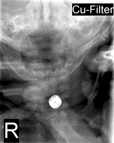 Zufallsbefund: links eine abheilende Claviculafraktur (klicken zum vergrößern)