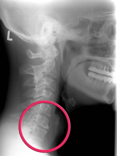 Osteochondrosen der unteren HWS nach Zahnproblemen